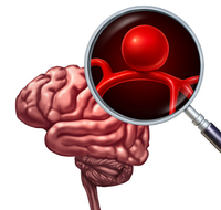 Aneurysma